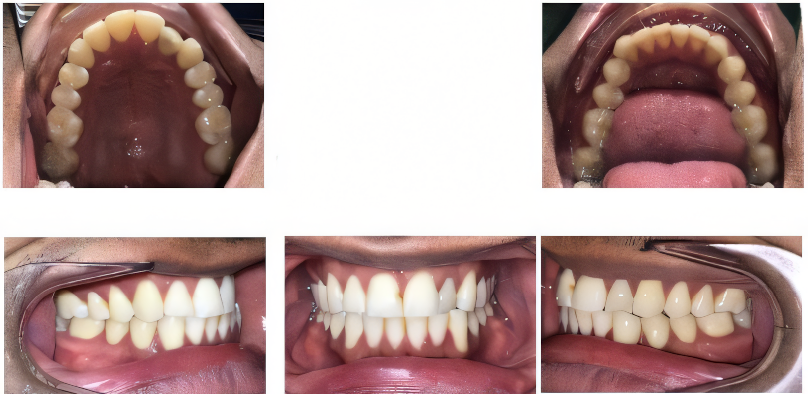 Invisalign touch up before